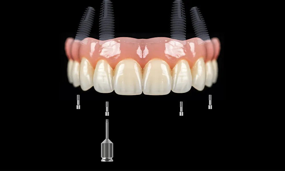 Bedančių žandikaulių atkūrimas (All-on-4)