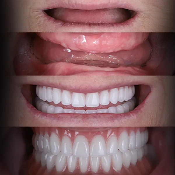 Bedančių žandikaulių atkūrimas (All-on-4)