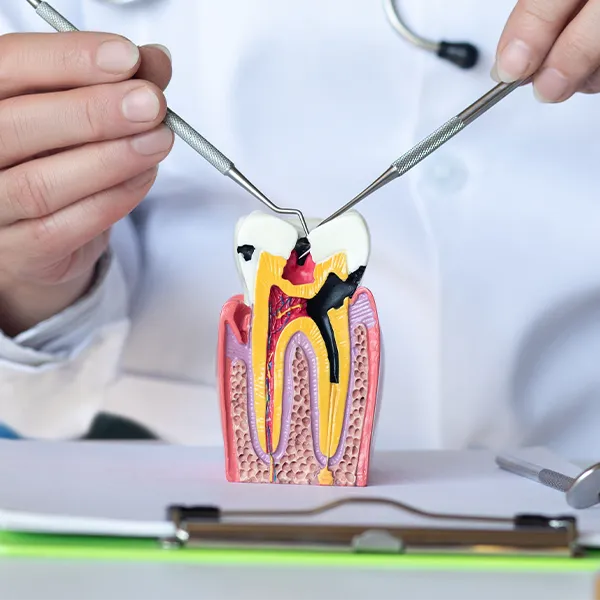 Dantų šaknų kanalų gydymas