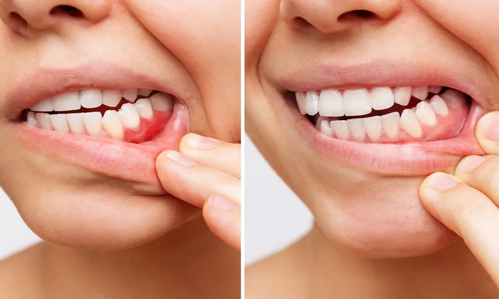Periodontologinis gydymas