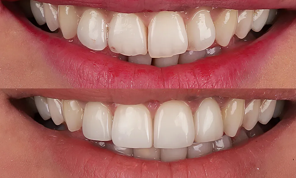 Estetinis plombavimas