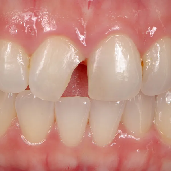 Estetinis plombavimas