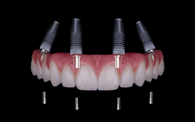 Visų vieno žandikaulio dantų atkūrimas su nuolatiniu protezu